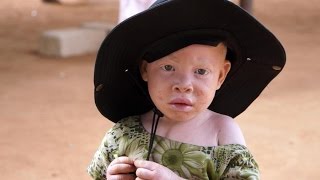 Documentaire L’Afrique albinos