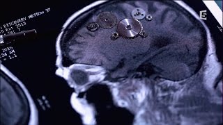 Documentaire Accidents vasculaires cérébraux, les bons réflexes