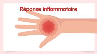 Documentaire Quel est le lien entre le psoriasis et le rhumatisme psoriasique ?