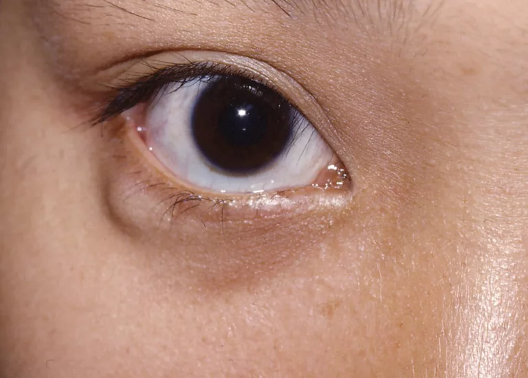 Article | Chalazion : comment s’en débarrasser