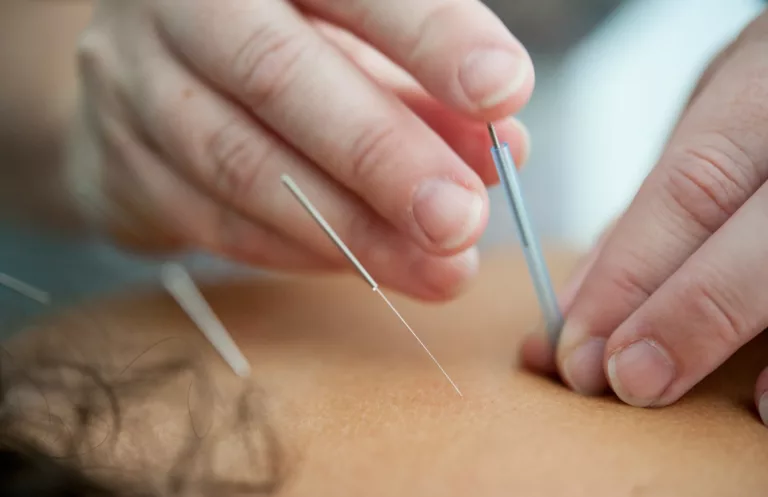 Article | L’acupuncture : une solution efficace contre le stress ?