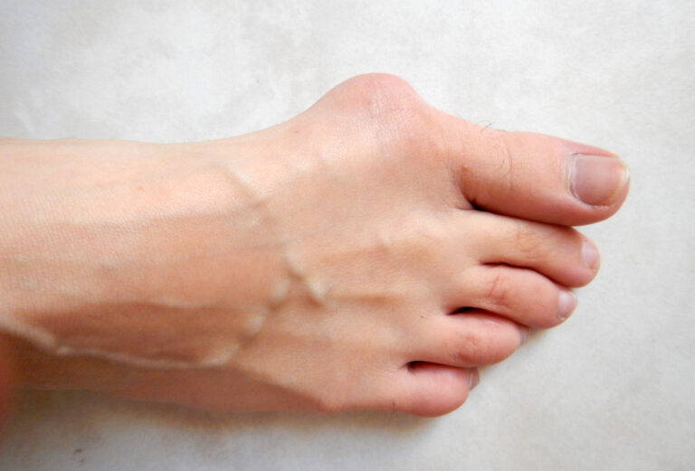 Article | Comment soigner un hallux valgus ?