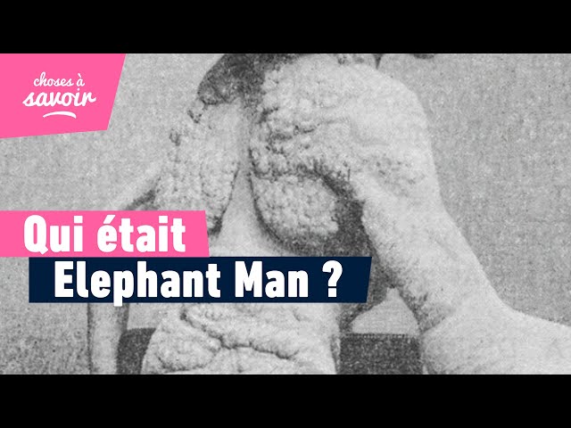 Qui était Elephant Man ?